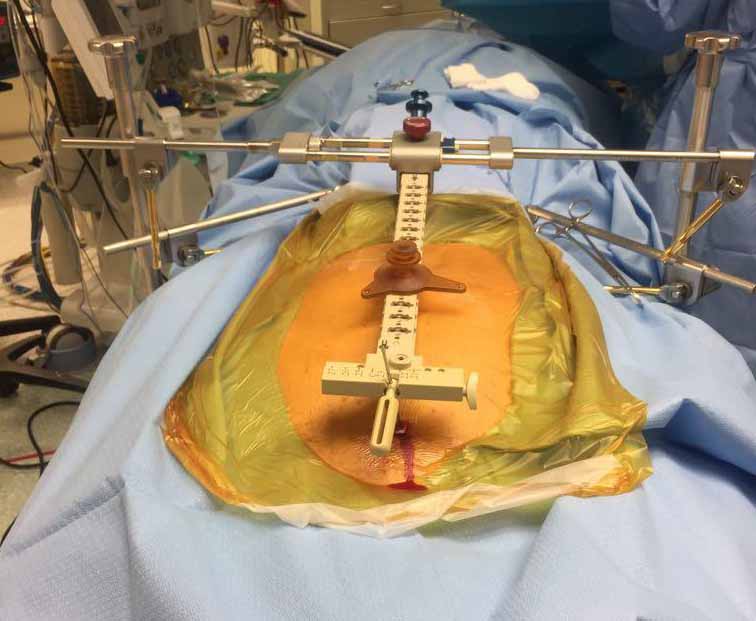 הדסה: ניתוח פורץ דרך עולמי בעמוד השדרה בסיוע רובוטים