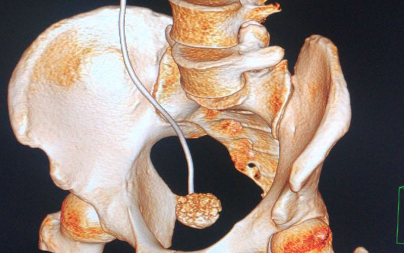 ריסוק אבני כליה (צילום: דוברות שערי צדק)