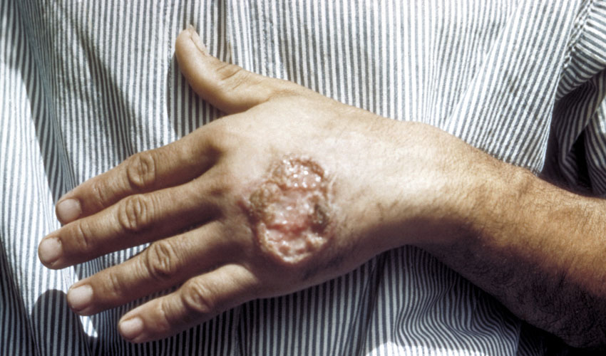 שושנת יריחו (צילום: מתוך ויקיפדיה,CDC Dr. D.S. Martin)
