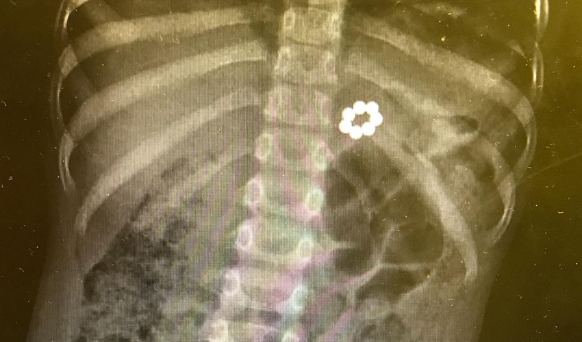 צילום רנטגן של ילד שבלע מגנטים (צילום: דוברות הדסה)