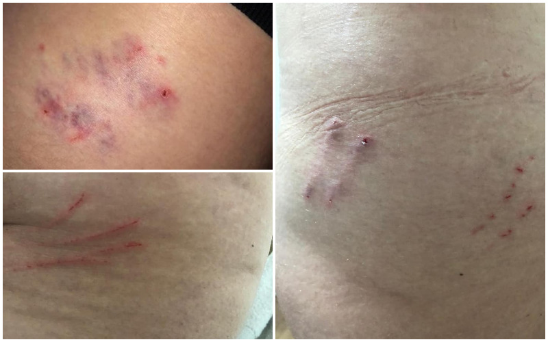 הפצעים על גופה של ענבל לאחר תקיפת חתולת הרחוב (צילומים: פרטי)
