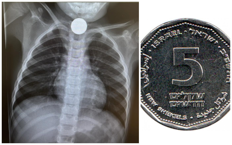 מטבע של 5 שקלים, צילום הרנטגן של הילד (צילומים: מאוחדת ירושלים)