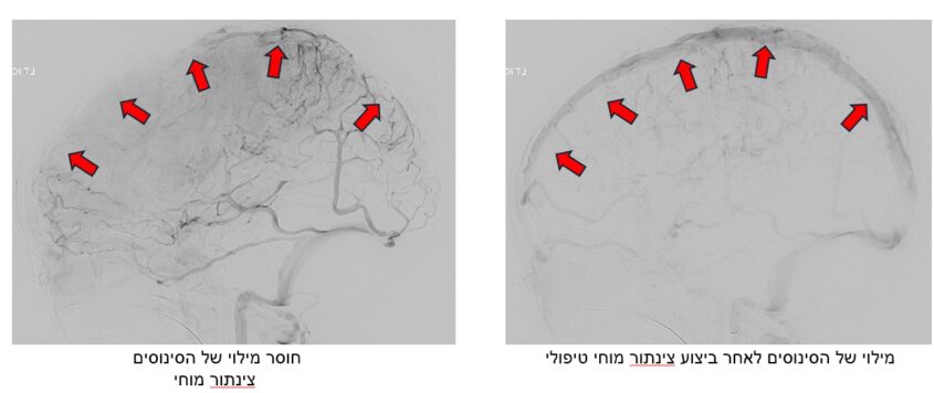 הסינוסים אחר ולפני ביצוע צינתור מוחי טיפולי (צילום: באדיבות שערי צדק)